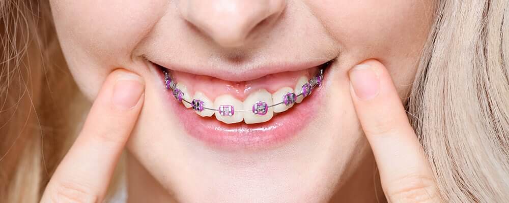 Reasons to Consider Invisalign as an Adult